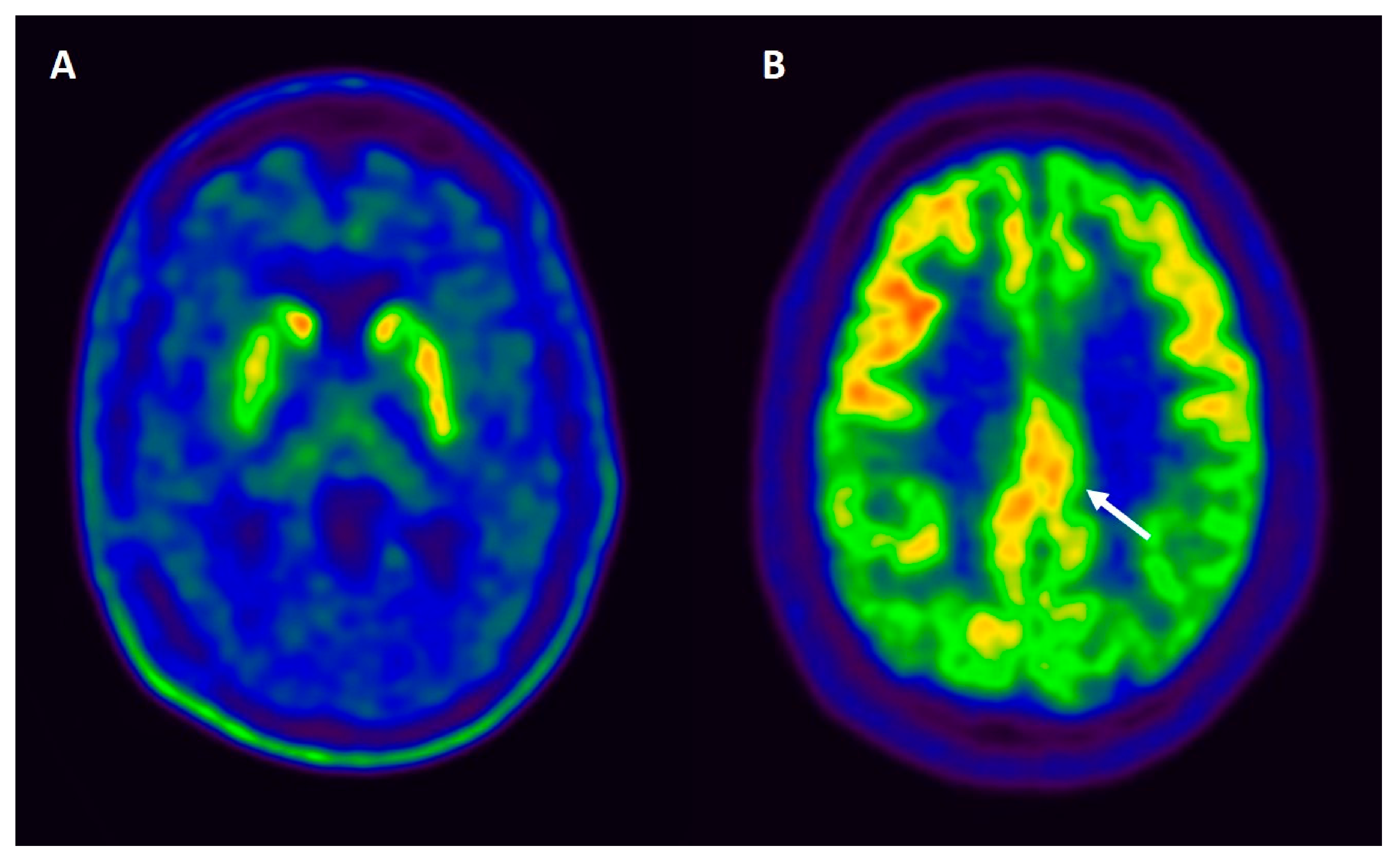 Behavioral Sciences | Free Full-Text | Lewy Body Dementias: A Coin with Two  Sides?