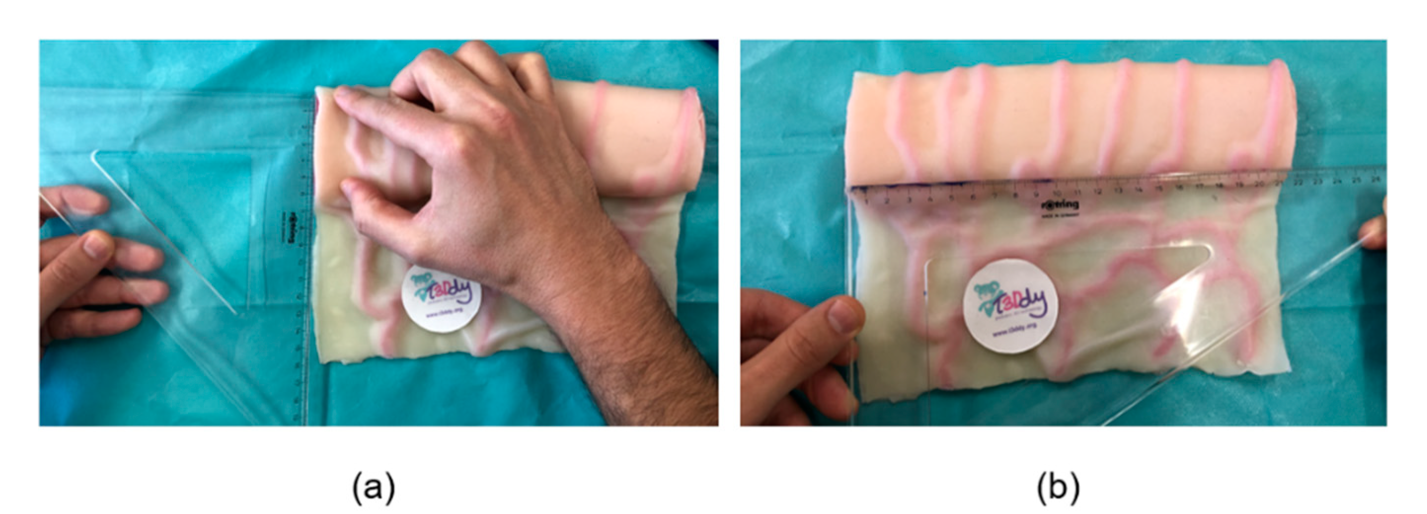Preoperative Planning of Spiral Intestinal Lengthening and Tailoring: A ...