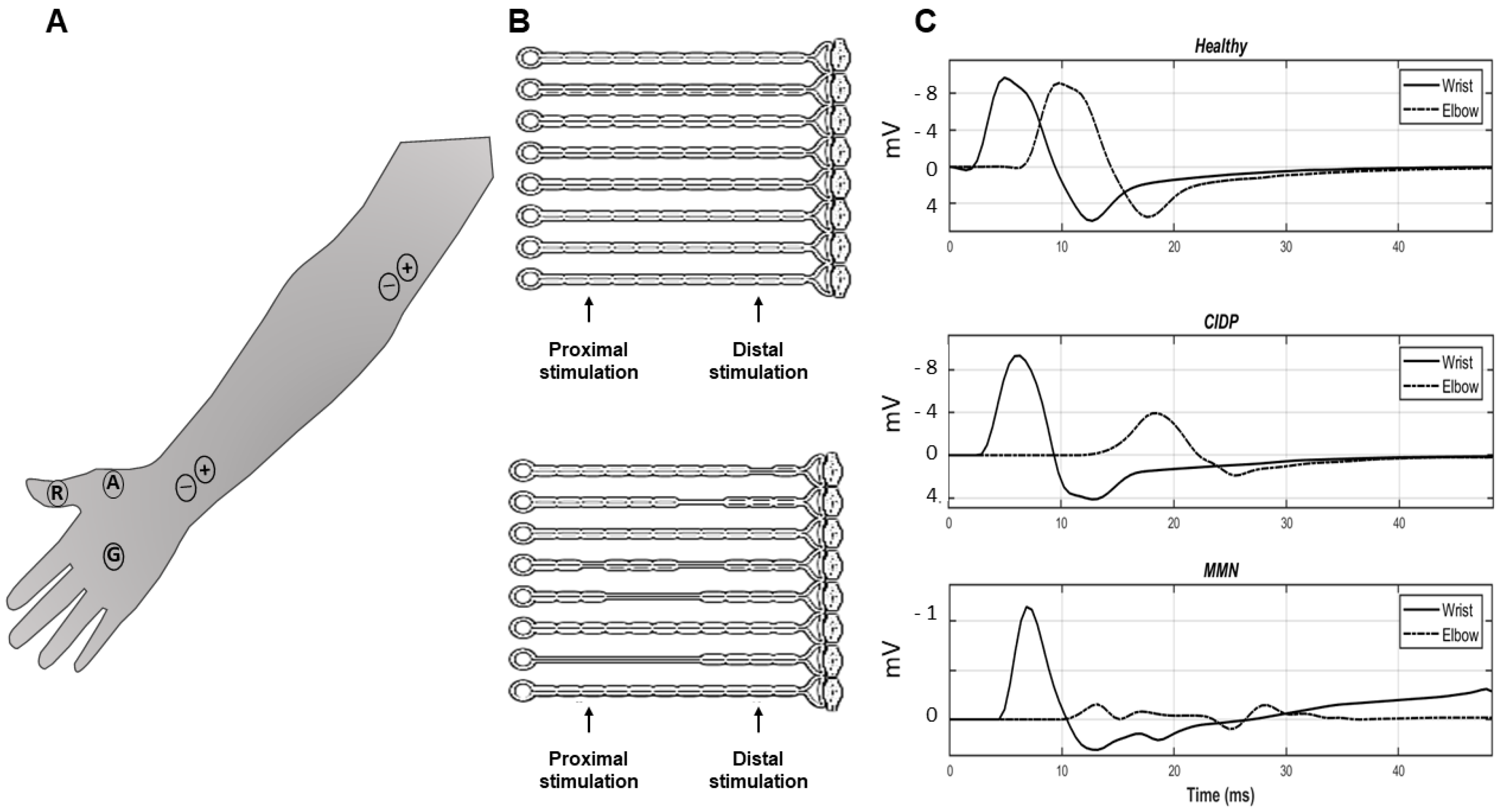 Bioengineering Free FullText Motor Nerve Conduction Block
