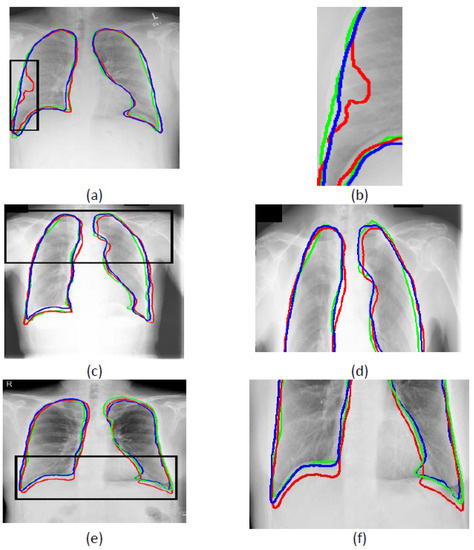 Lung Field Segmentation in Chest X-ray Images Using Superpixel Resizing ...