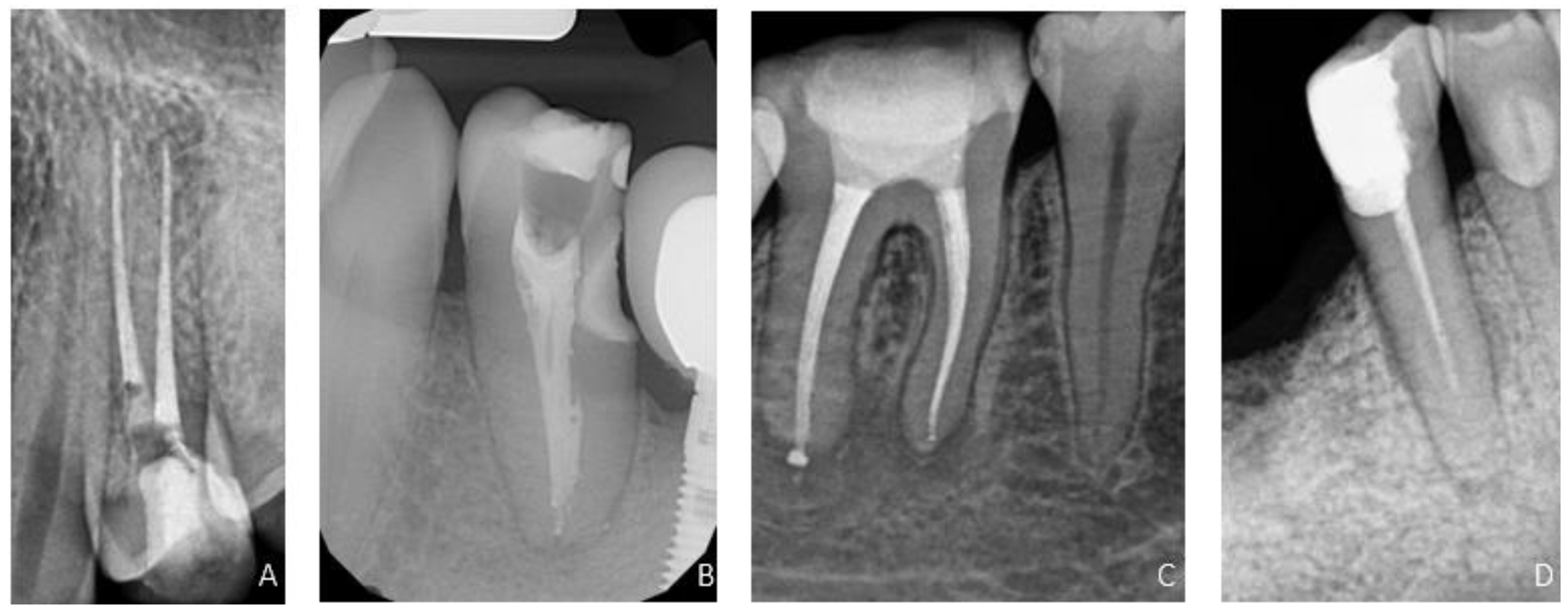 Bioengineering | Free Full-Text | The Assessment of Quality of the Root  Canal Filling and the Number of Visits Needed for Completing Primary Root  Canal Treatment by Operators with Different Experience