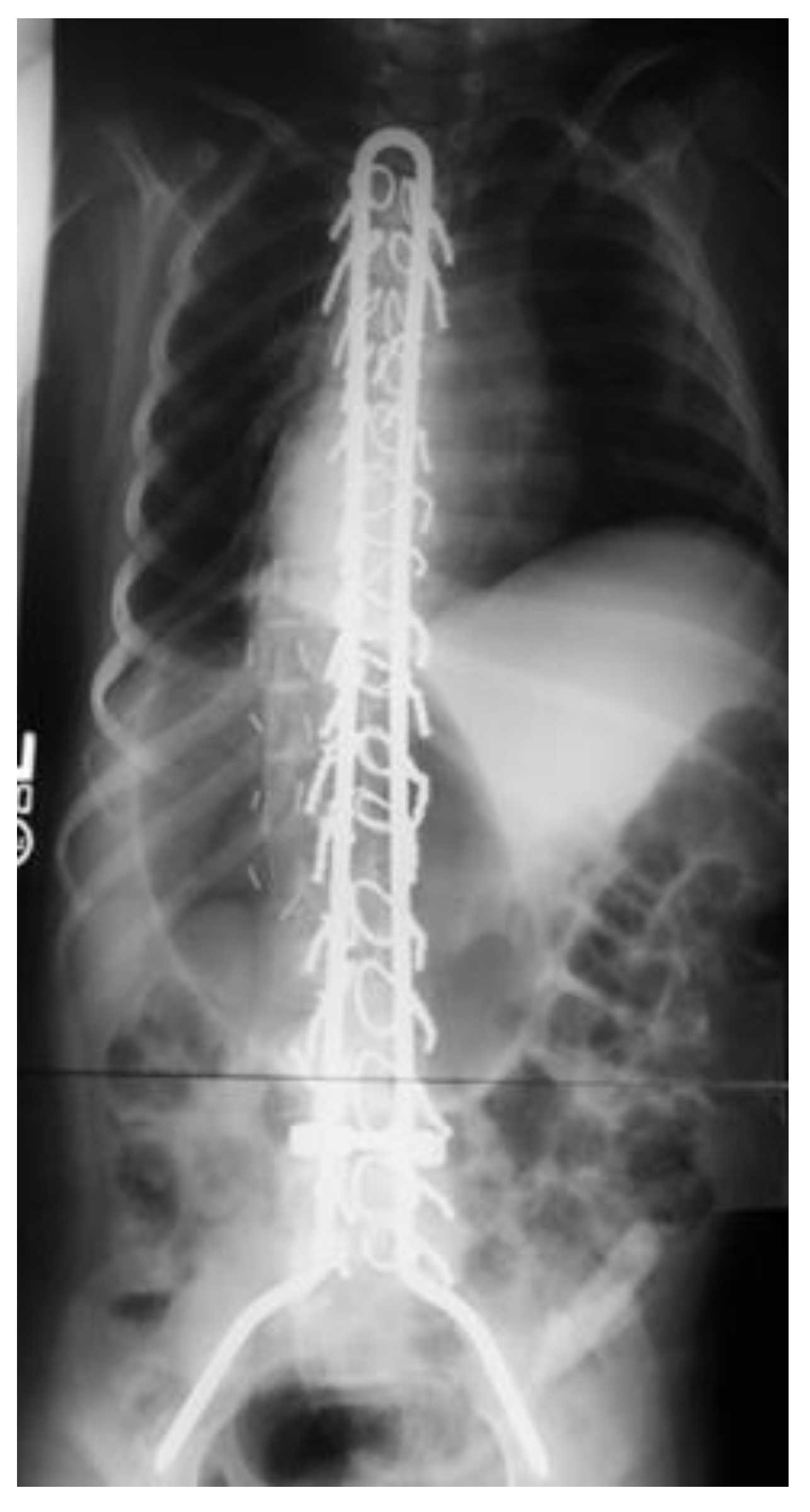 Operate Now: Scoliosis Surgery 