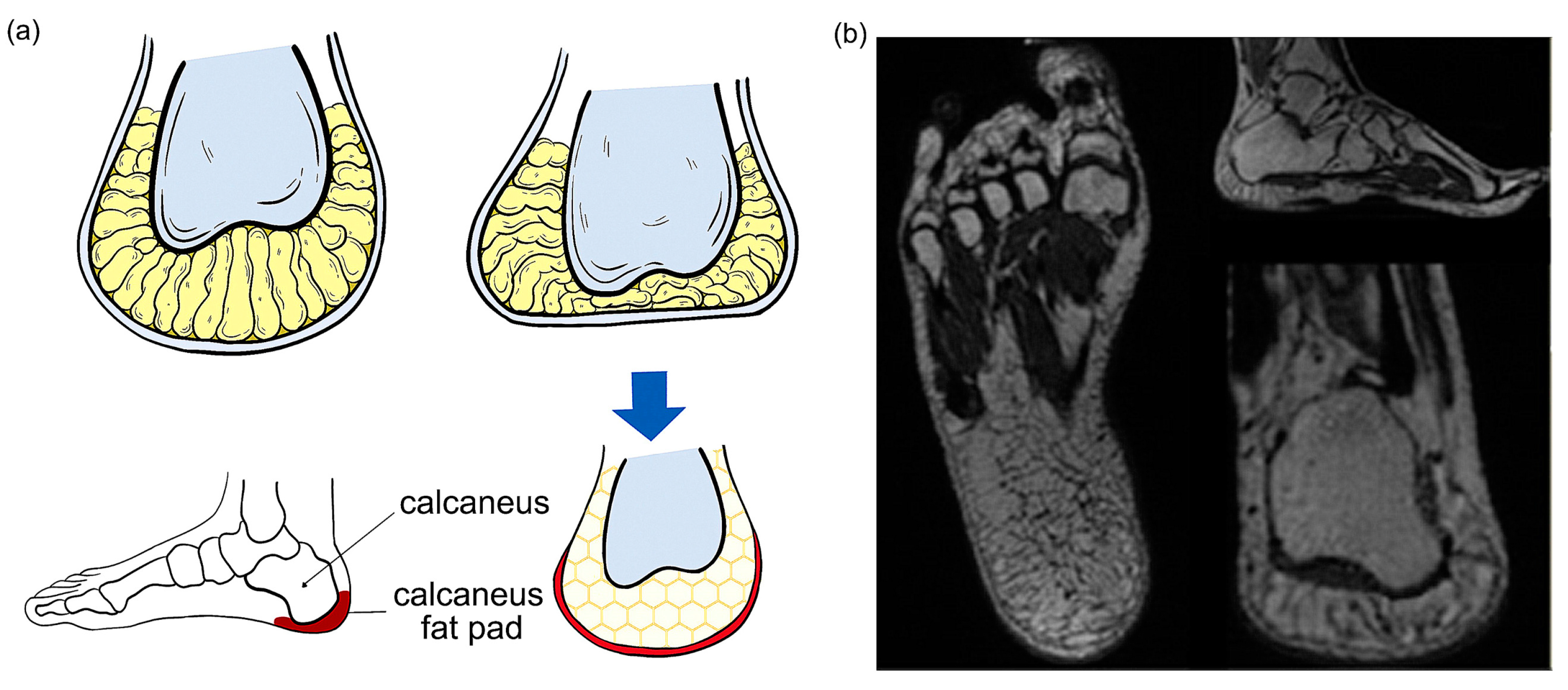Evaluation of plantar fasciitis improvement after shock wave therapy in  calcaneal spur patients by musculoskeletal ultrasonography | Egyptian  Rheumatology and Rehabilitation | Full Text