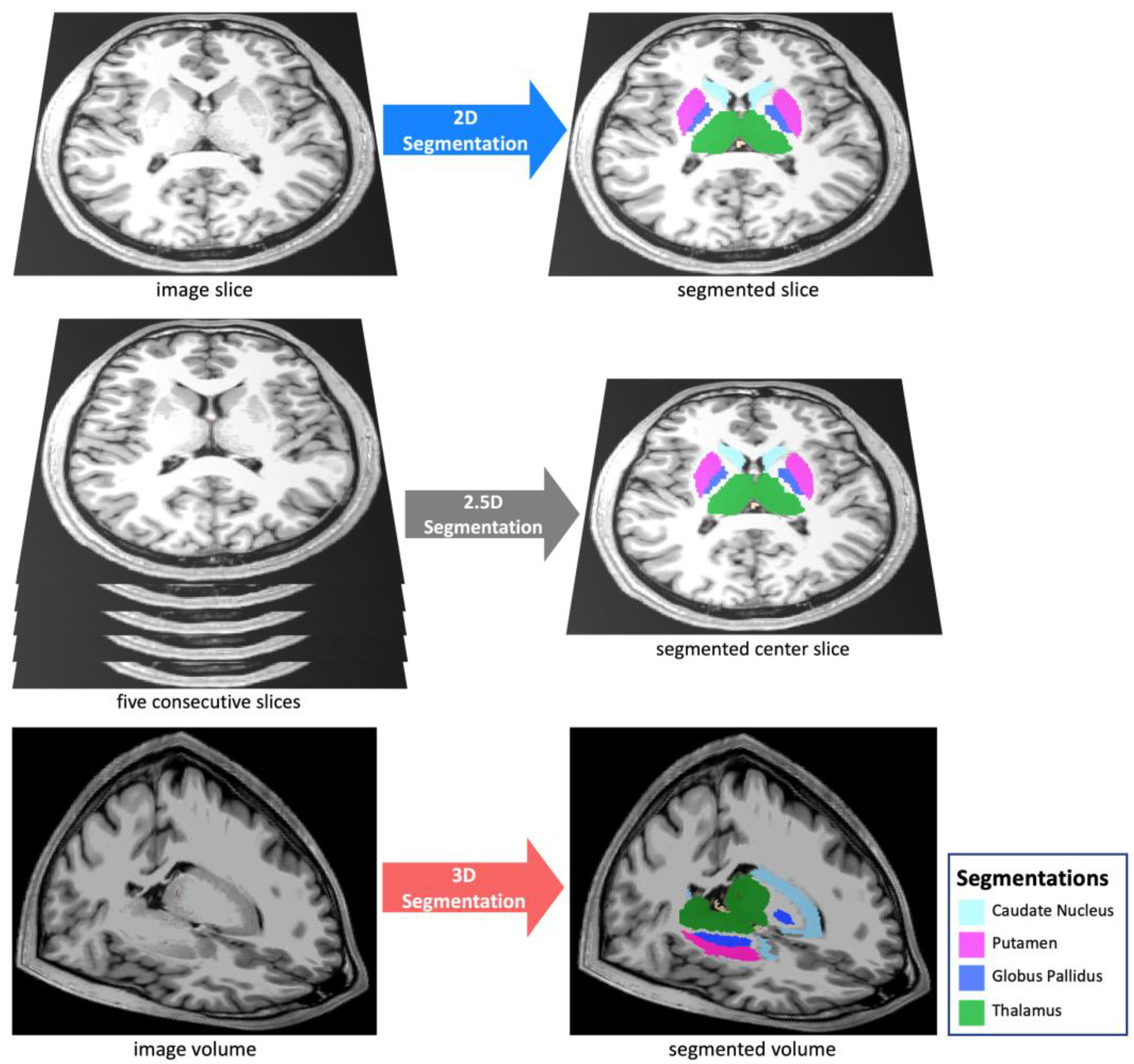 θcomplex3 eYecandy vs. θcomplex Comparing 3D, 2.5D, and 2D Approaches to Brain Image Auto