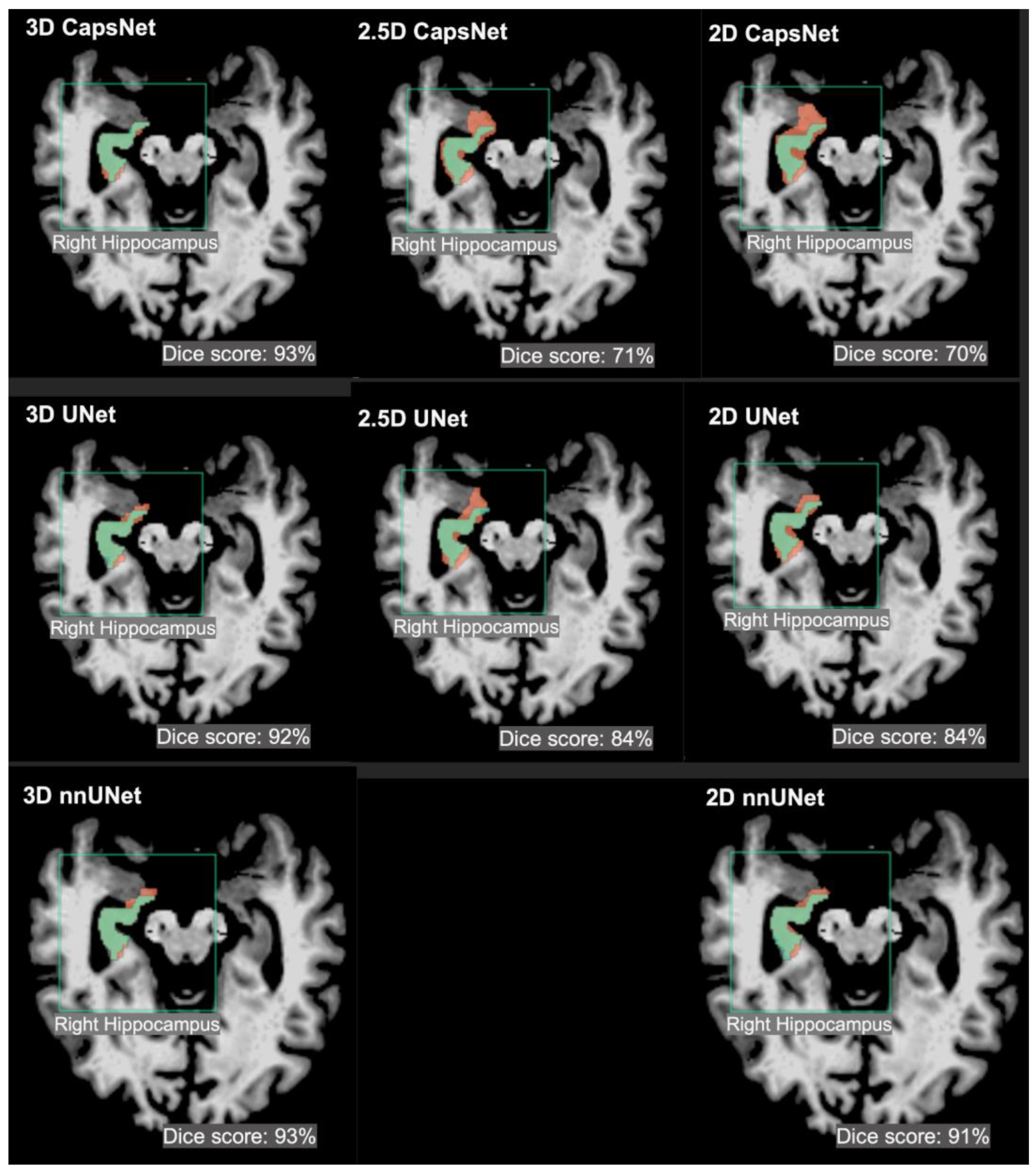 θcomplex3 eYecandy vs. θcomplex Comparing 3D, 2.5D, and 2D Approaches to Brain Image Auto