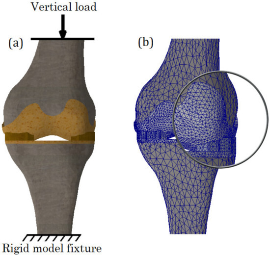Modeling the Impact of Meniscal Tears on von Mises Stress of Knee ...