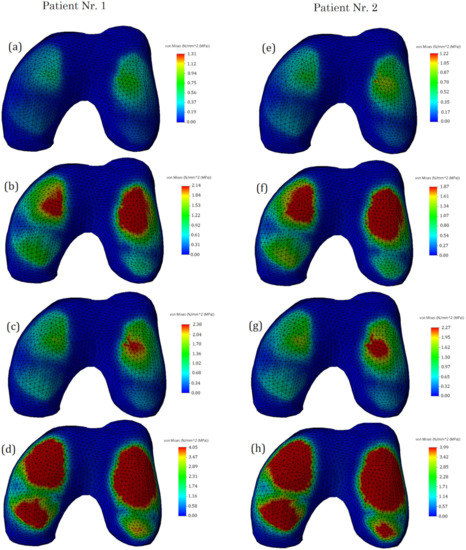 Modeling the Impact of Meniscal Tears on von Mises Stress of Knee ...