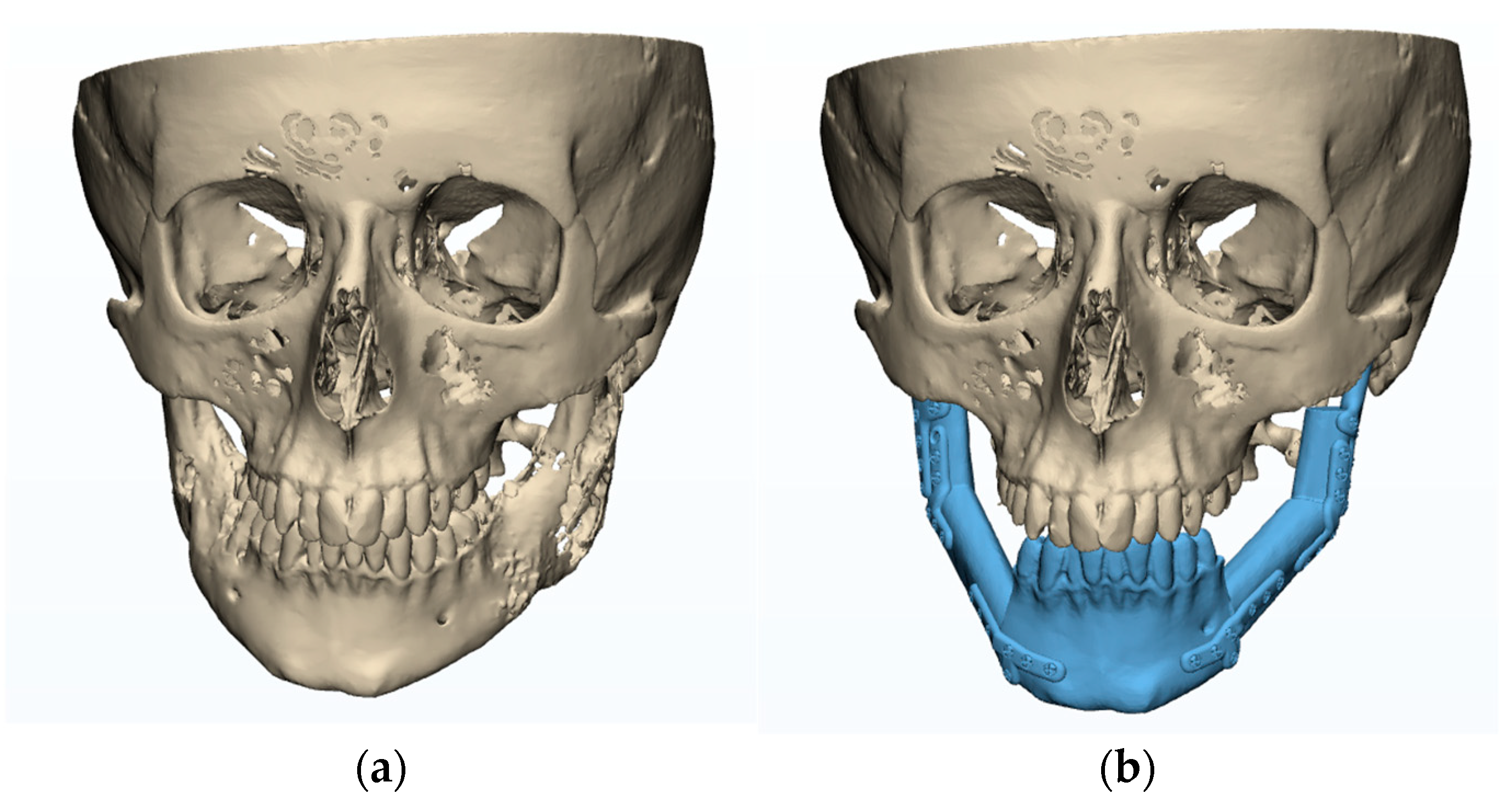 Biomechanical Evaluation of Temporomandibular Joint