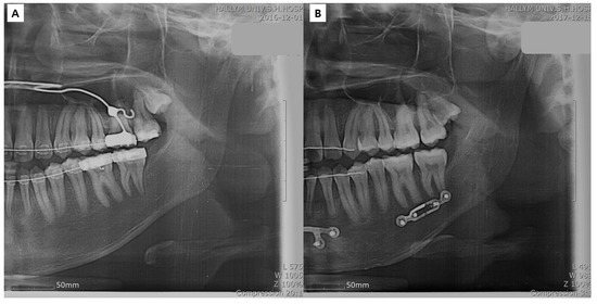 8個セット Clinical Stability of Bespoke Snowman Plates for Fixation