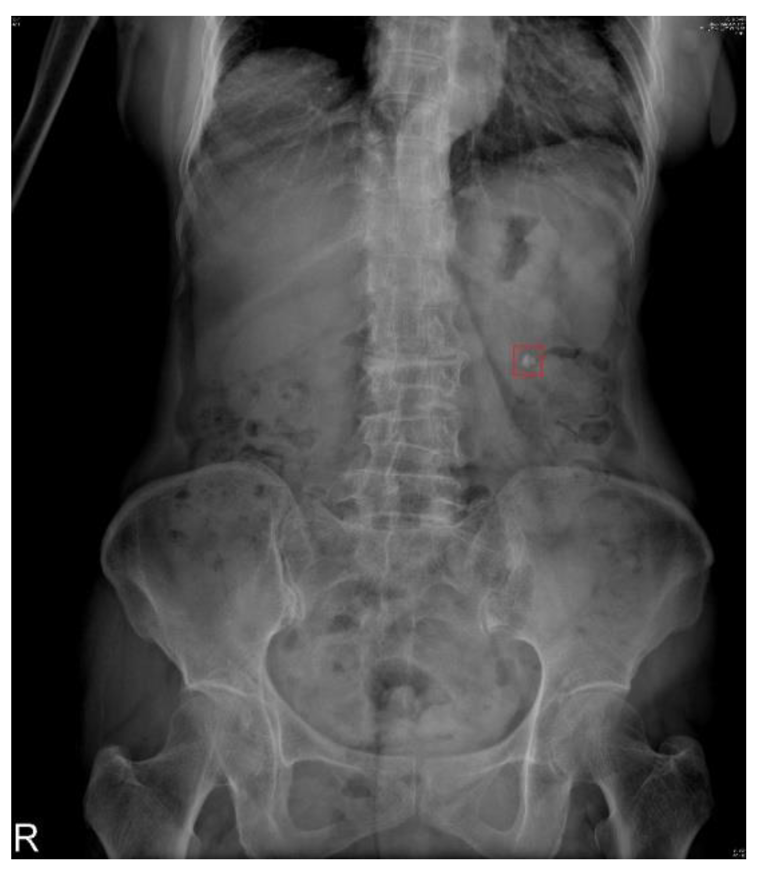 Bladder Stones - Z Urology