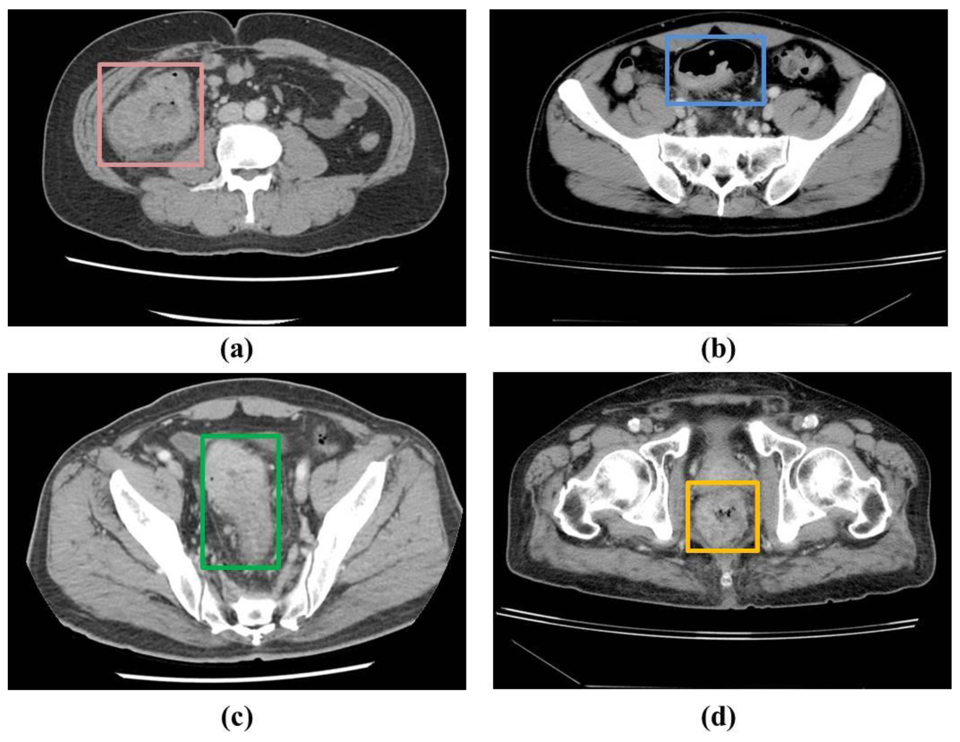 Bioengineering Free Full-Text Localization of Colorectal Cancer Lesions in Contrast-Computed Tomography Images via a Deep Learning Approach