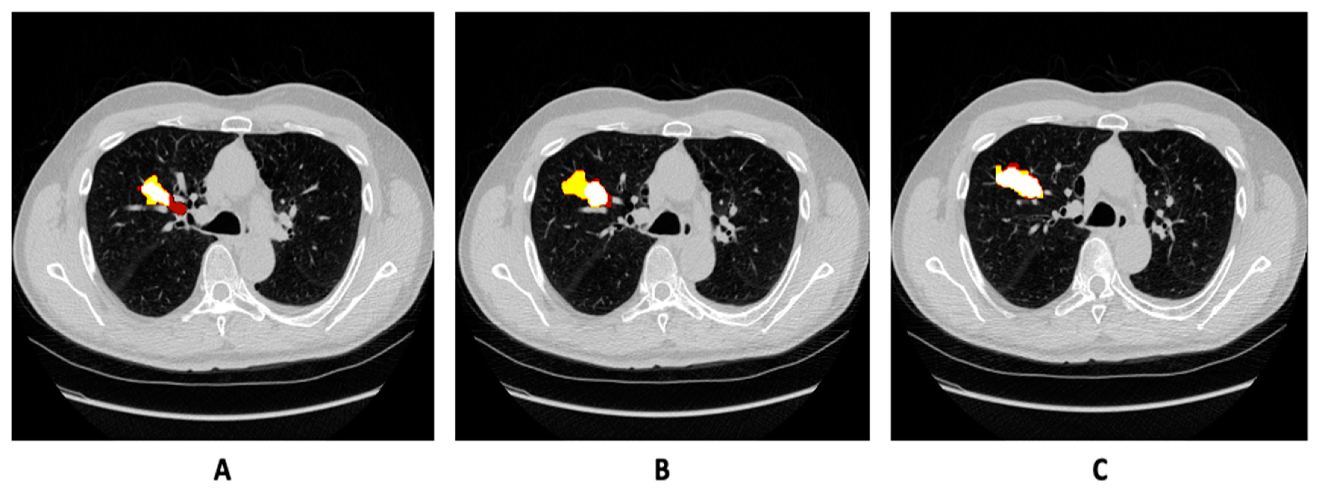 Bioengineering Free FullText Lung Tumor Image Segmentation from