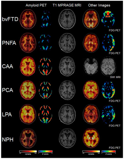 Application of Deep Learning for Prediction of Alzheimer’s Disease in ...