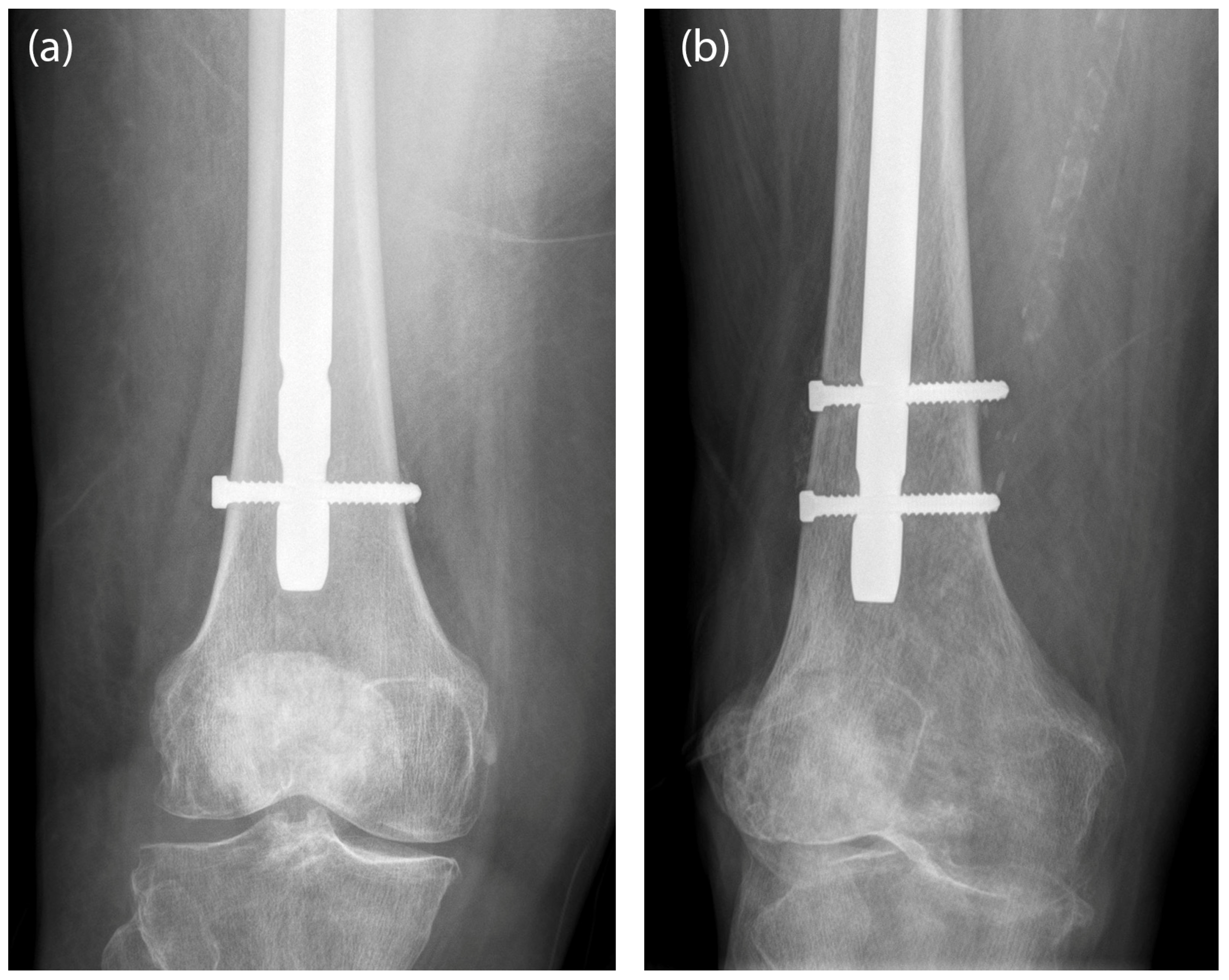 Zimmer® Natural Nail® System Antegrade Femoral Surgical Technique