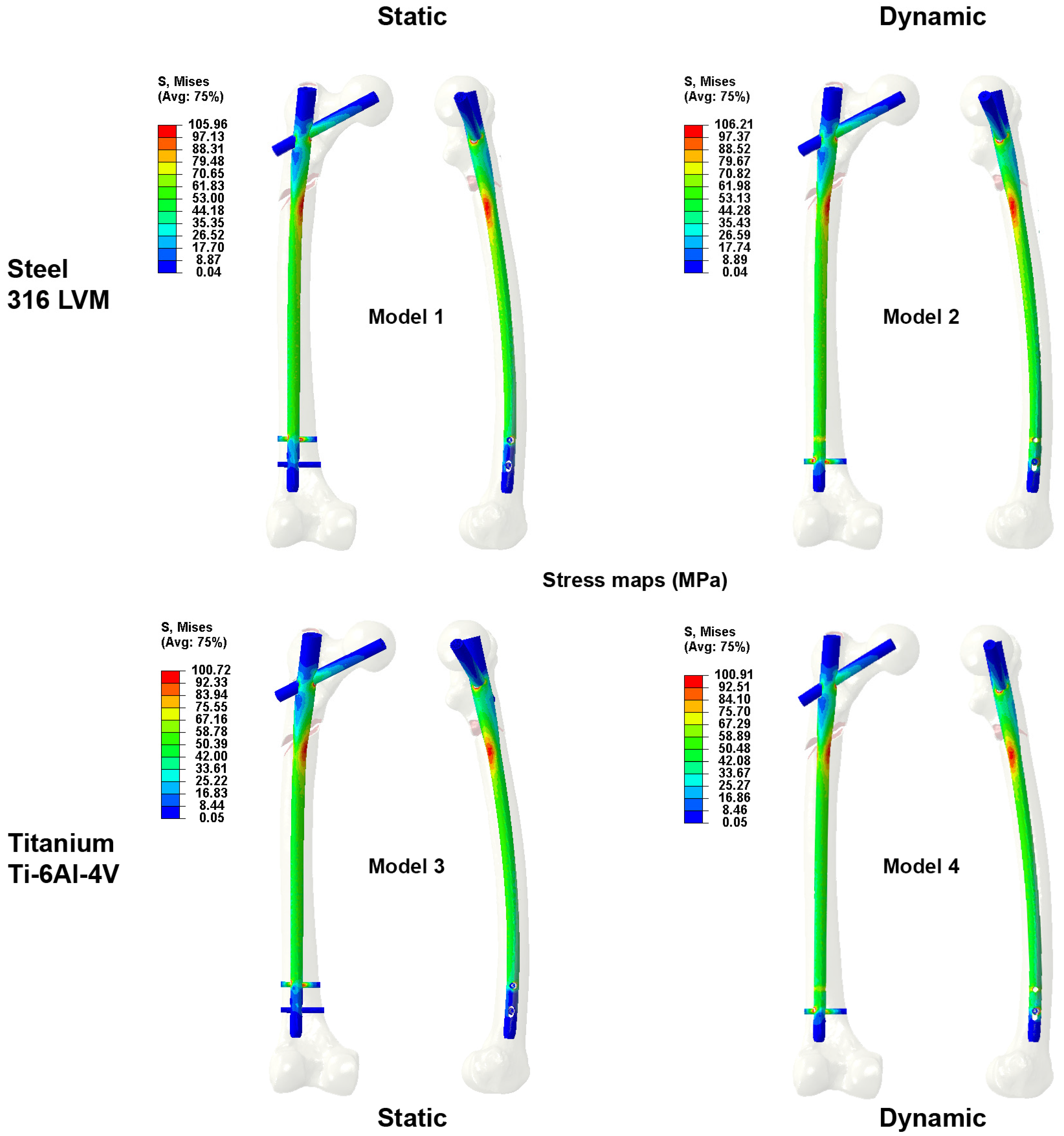 Surgical Approaches for Charcot Foot - Orthofix