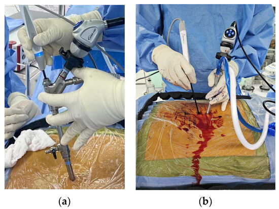Future of Endoscopic Spine Surgery: Insights from Cutting-Edge 
