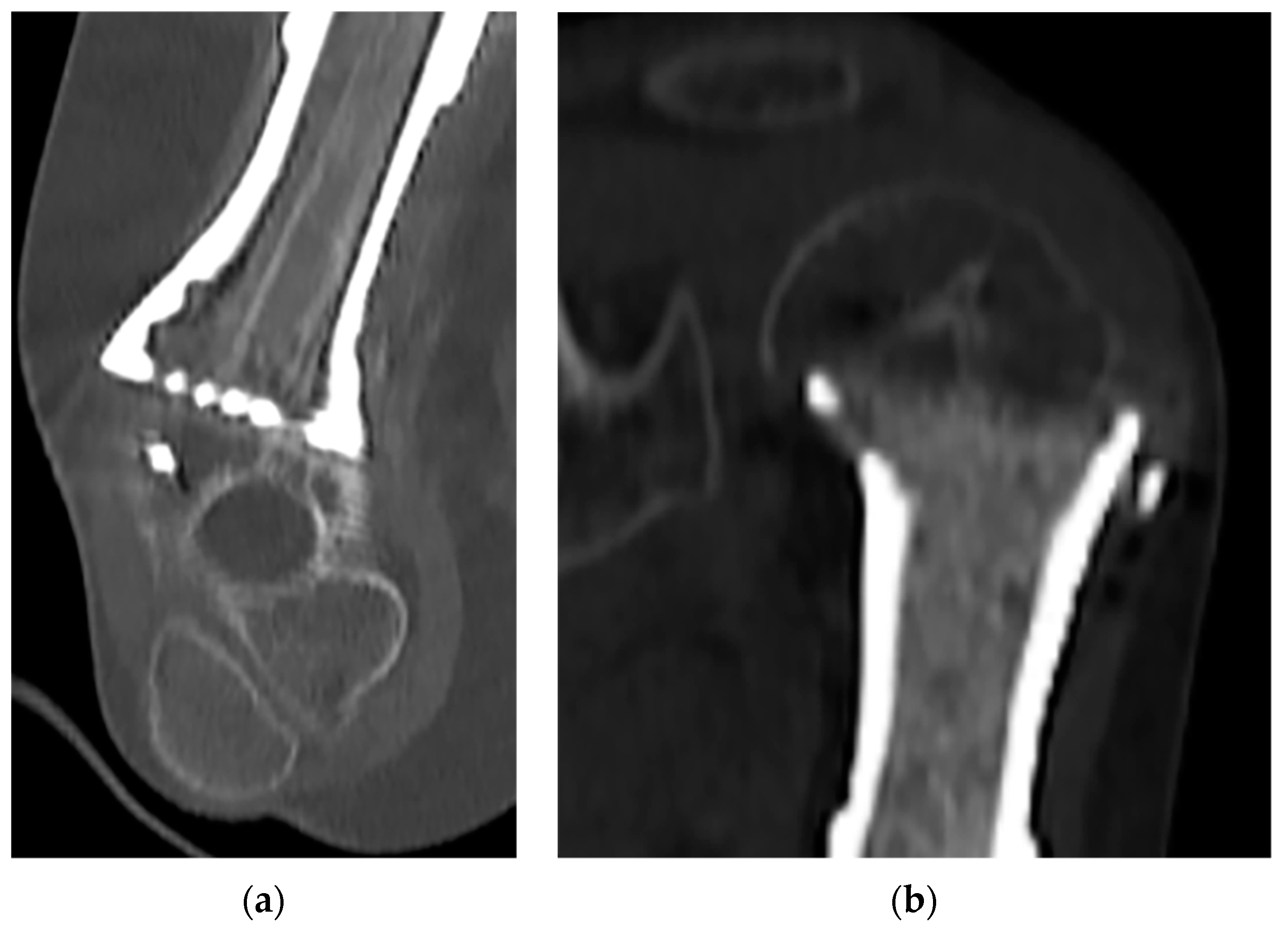Biological Prosthesis (Hollow 3D-Printed Titanium Custom