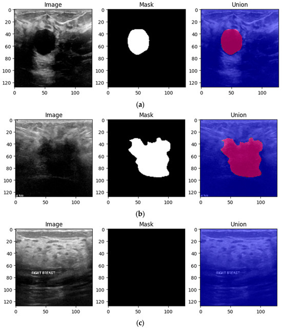 Multi-Instance Classification of Breast Tumor Ultrasound Images Using ...