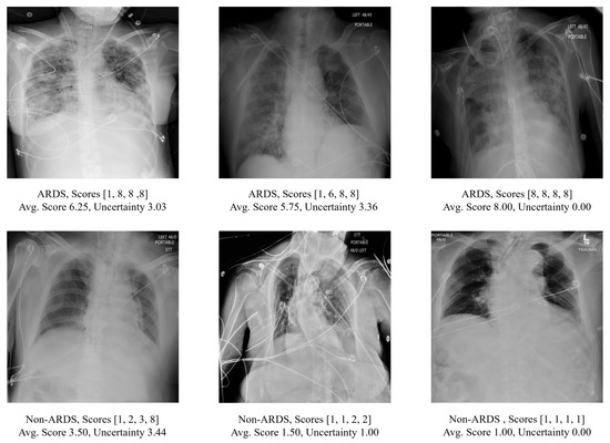 Bioengineering | Free Full-Text | Leveraging Multi-Annotator Label  Uncertainties as Privileged Information for Acute Respiratory Distress  Syndrome Detection in Chest X-ray Images