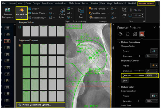 Digital Templating of Hip Arthroplasty Using Microsoft PowerPoint: A ...