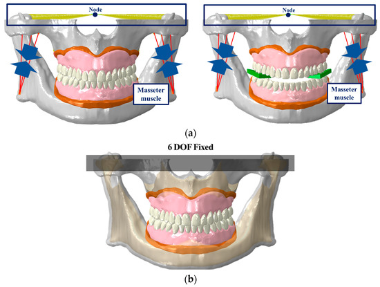 A Finite Element Analysis Study of Edentulous Model with Complete