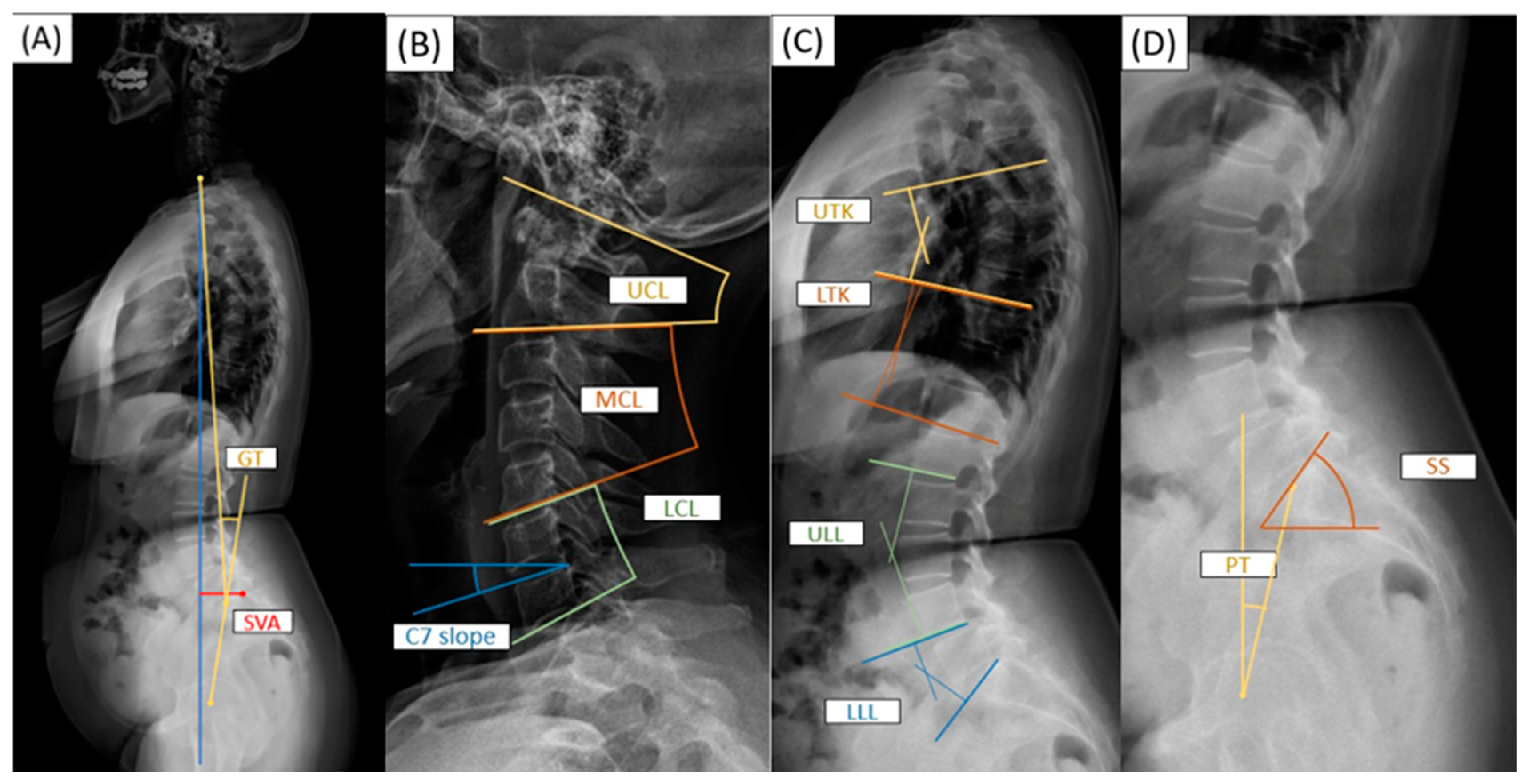 Research of Global Tilt and Functional Independence