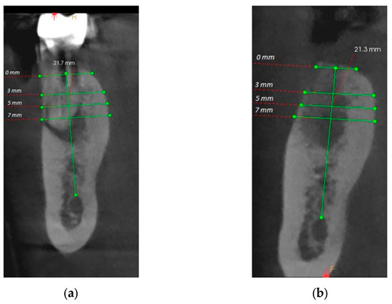 Healing of Extraction Sites after Alveolar Ridge Preservation Using ...