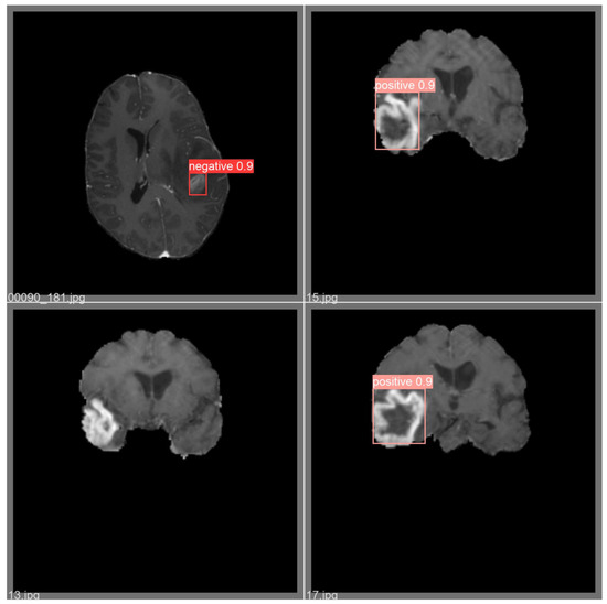 Enhancing Automated Brain Tumor Detection Accuracy Using Artificial ...