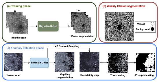 Anomaly Detection in Optical Coherence Tomography Angiography (OCTA ...