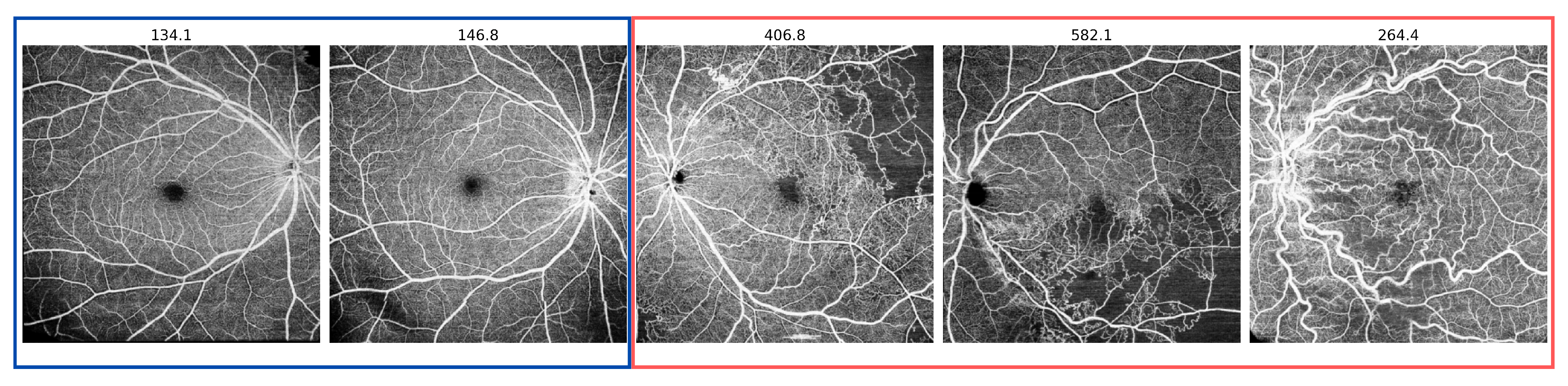 Anomaly Detection in Optical Coherence Tomography Angiography (OCTA ...
