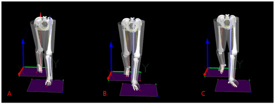 Influence of Internal and External Foot Rotation on Peak Knee Adduction ...