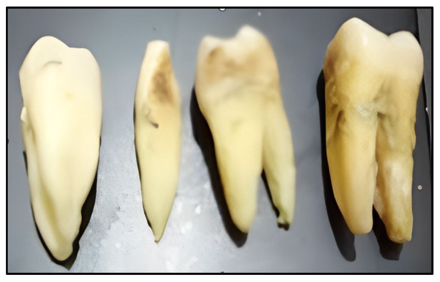 The Effects of Khat Chewing among Djiboutians: Dental