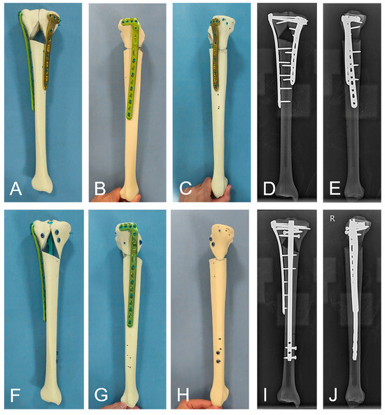 A Biomechanical Comparison Study of Plate–Nail and Dual