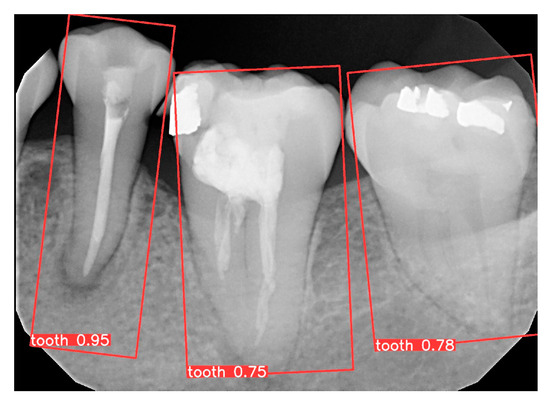 Precision Medicine for Apical Lesions and Peri-Endo Combined Lesions ...