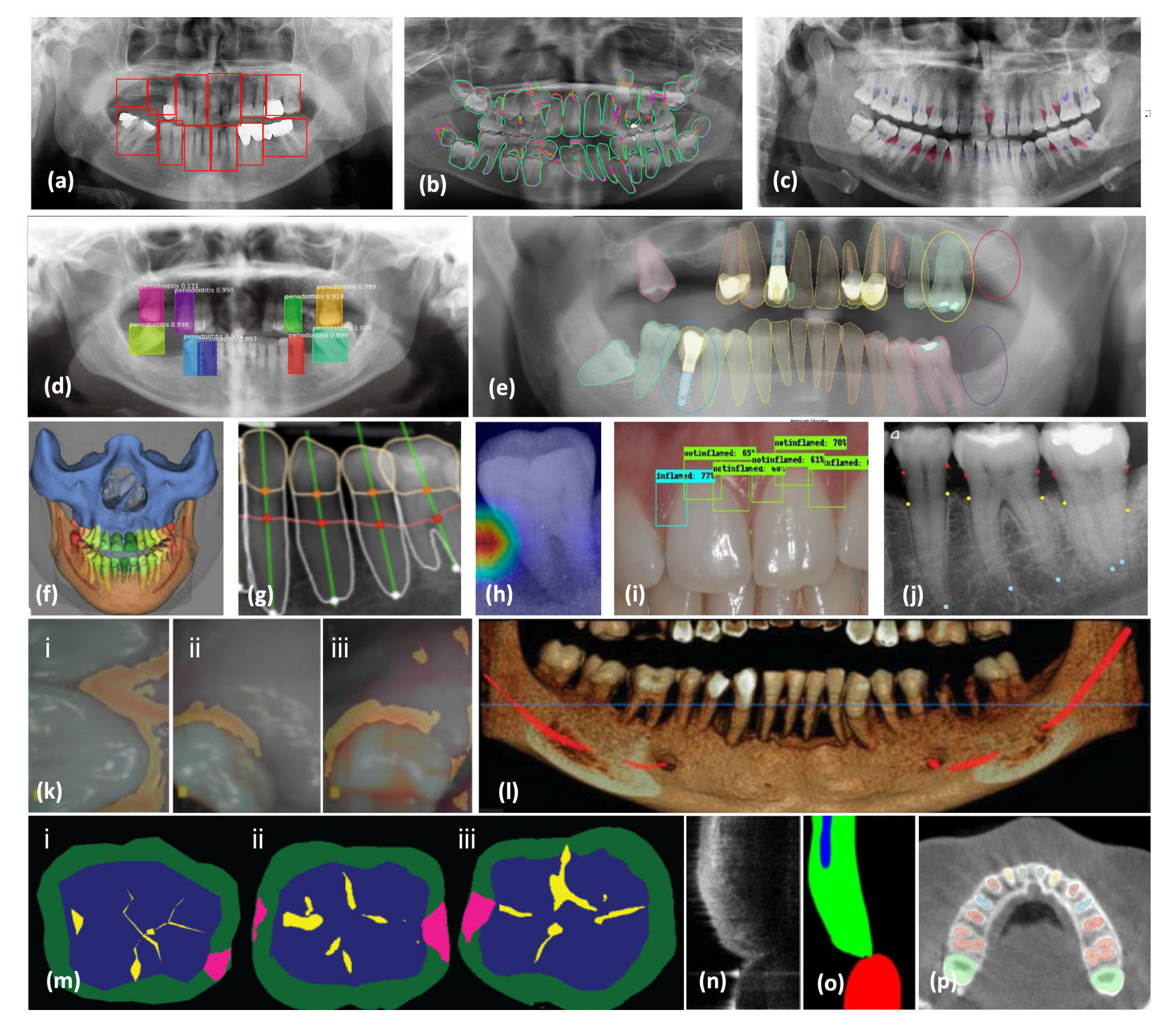ペリオドンタル・デブライドメント = Periodontal debridem… ペリオドンタル・デブライドメント = Periodontal debridem…