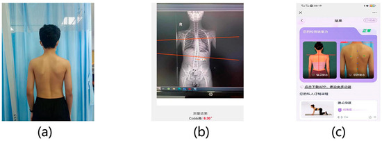 Intelligent Evaluation Method for Scoliosis at Home Using Back Photos ...