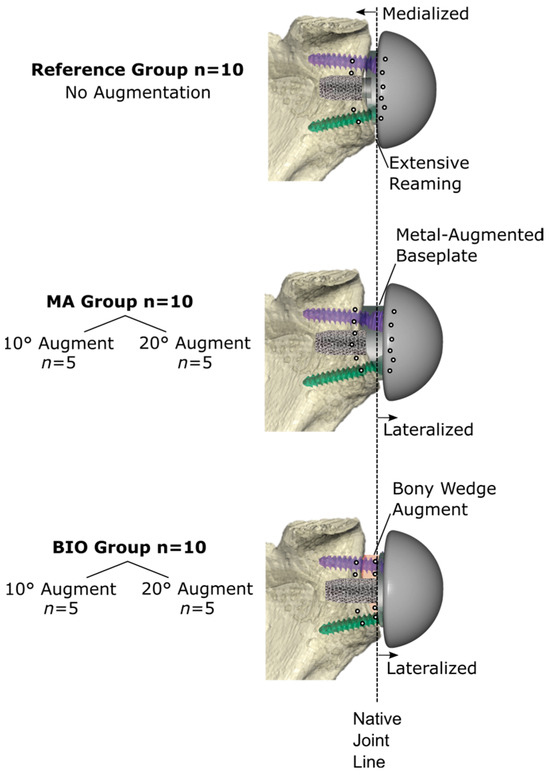 Reverse Shoulder Arthroplasty Baseplate Stability Is Affected by 