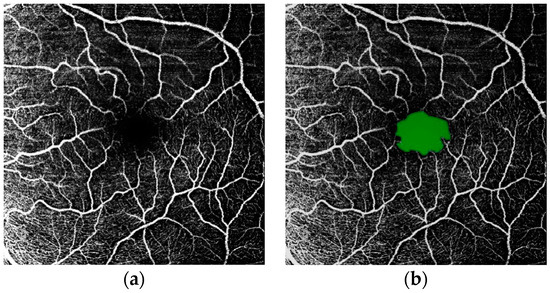 Automated Foveal Avascular Zone Segmentation in Optical Coherence ...