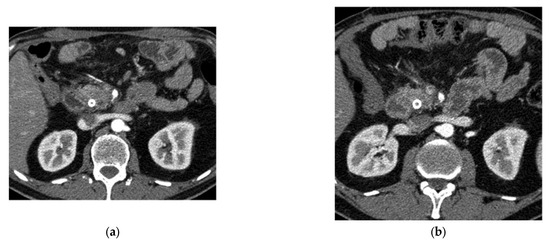 Advancements in Radiomics-Based AI for Pancreatic Ductal