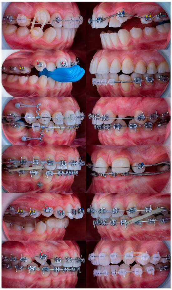 Orthodontic Biomechanical Reasoning with Multimodal Language
