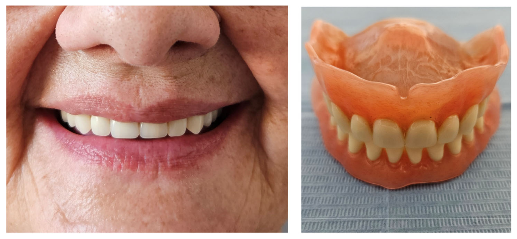 A Manufacturing Protocol for Complete Dentures Using a Milling