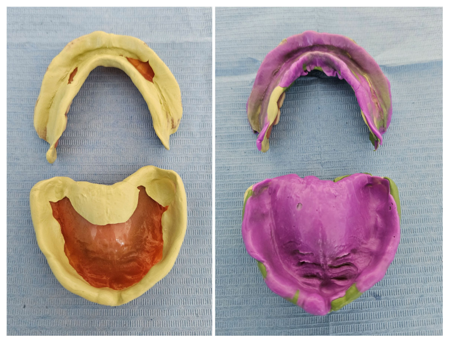 A Manufacturing Protocol for Complete Dentures Using a Milling