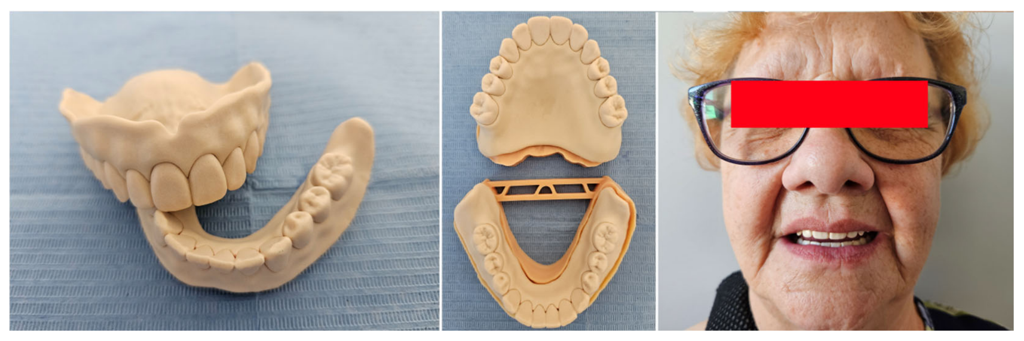 A Manufacturing Protocol for Complete Dentures Using a Milling