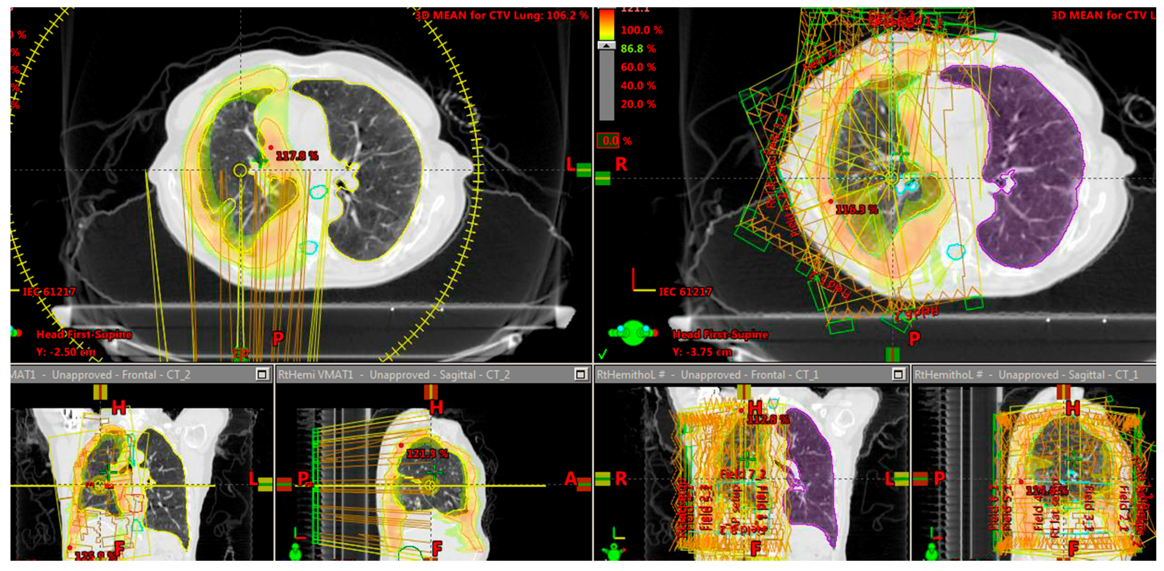 can a ct angiogram detect lung cancer