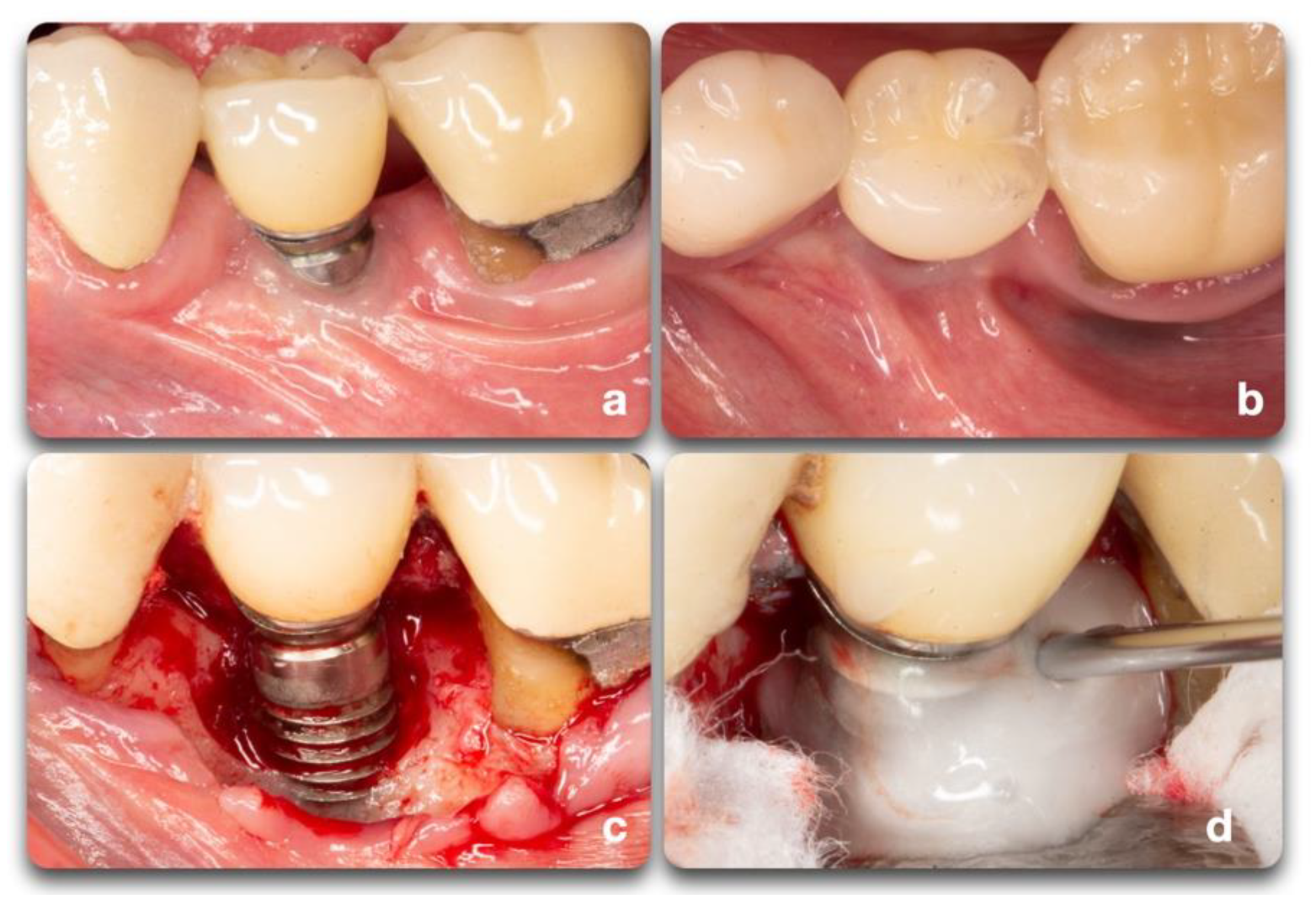 Peri-Implantitis Regenerative Therapy: A Review