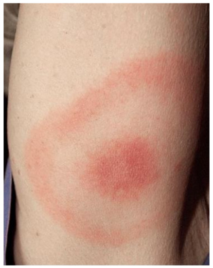 Is This a Breast Rash Caused by South American Larvae?