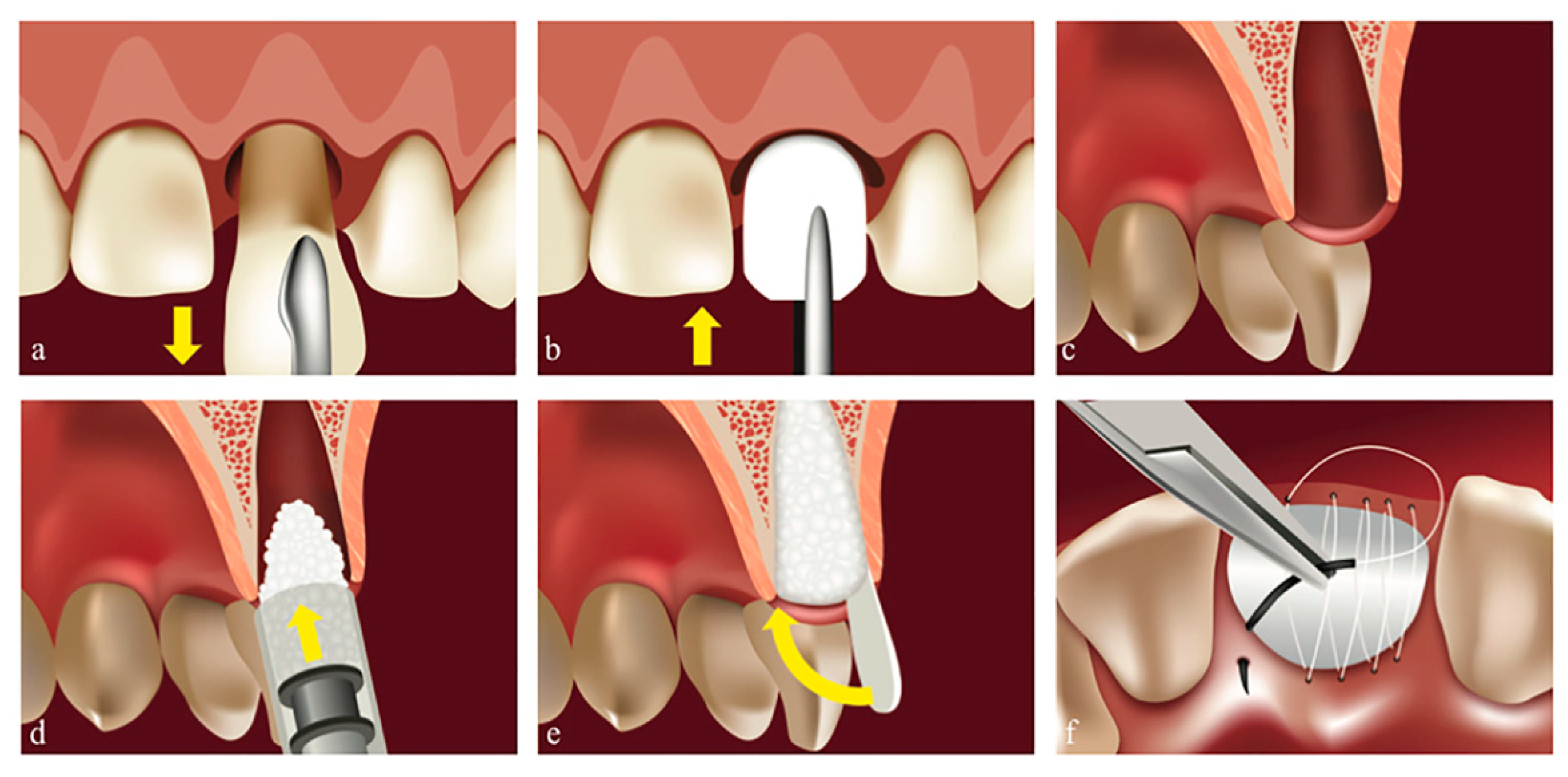 Biology Free FullText Open Healing A Minimally Invasive Protocol