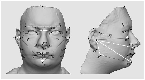 Robustness of Distinctive Facial Features in Prader-Willi Syndrome: A ...