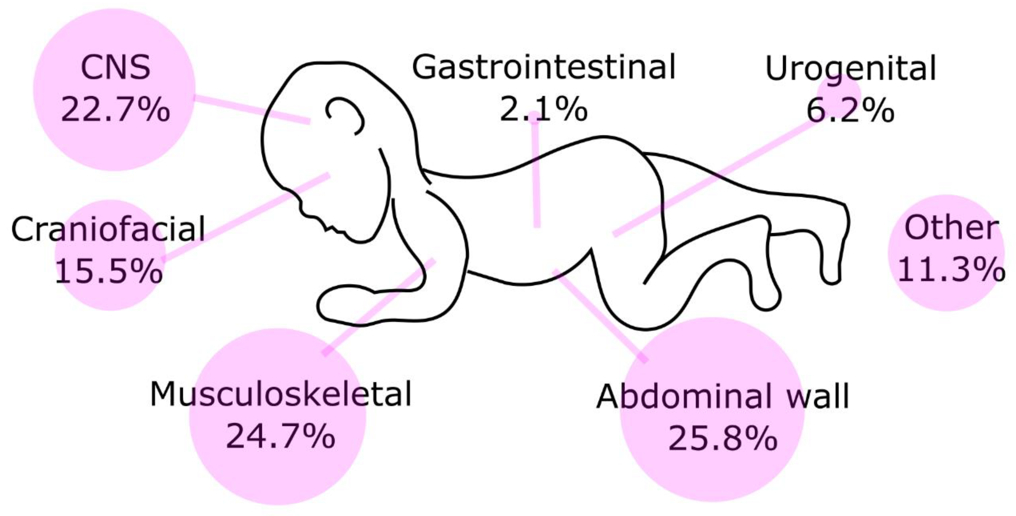 NonIsolated Neural Tube Defects with Comorbid Malformations Are