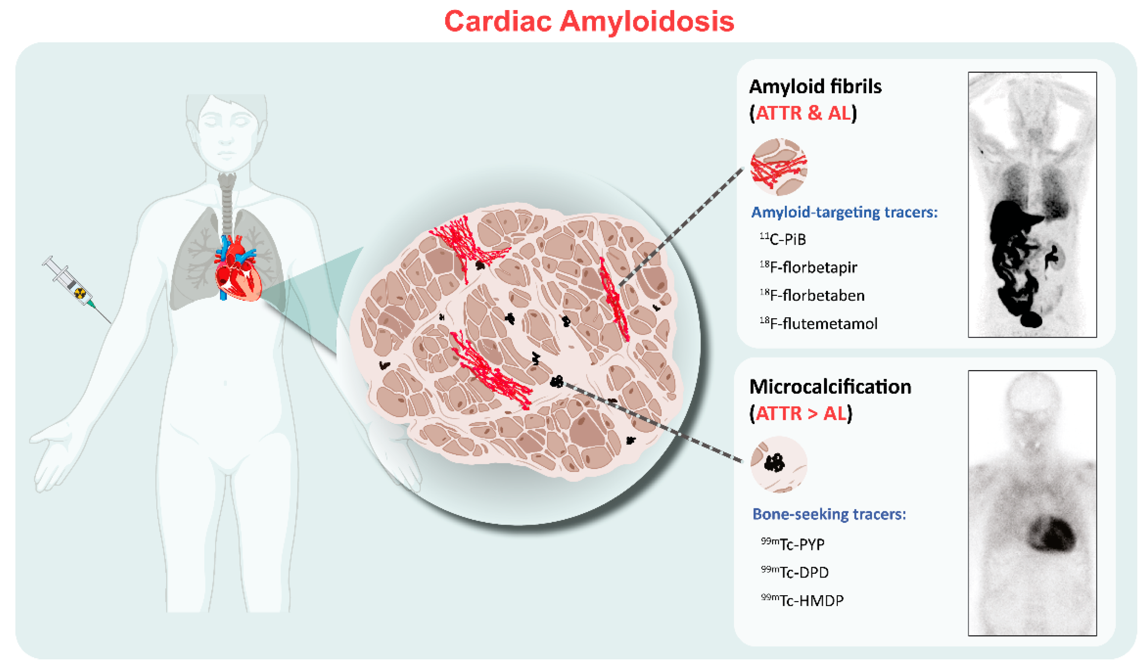 Diagnostic and prognostic value of cardiac imaging in amyloidosis